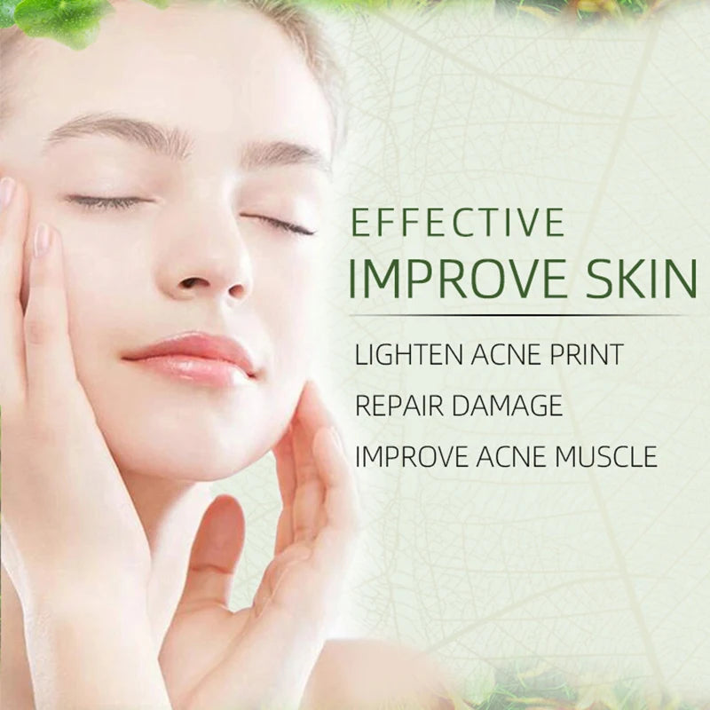 JoyPretty Herbal Anti-Acne Face Cream, 50g