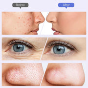 Windaily Wireless Diamond Microdermabrasion Machine