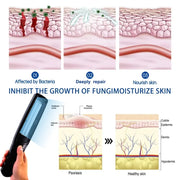 311nm UVB Phototherapy Lamp