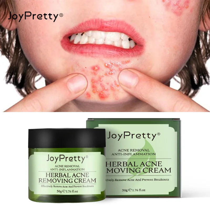 JoyPretty Herbal Anti-Acne Face Cream, 50g